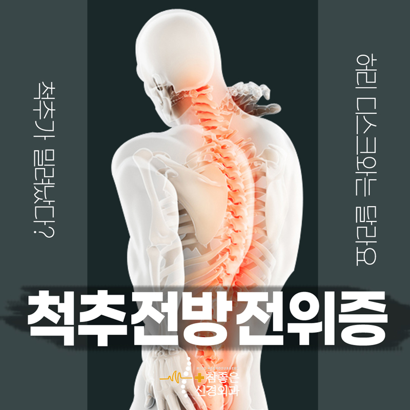 수영구 척추병원 허리디스크와는 다른 척추전방전위증